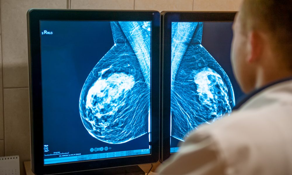 German AI platform raises €4.5m to transform breast cancer screening