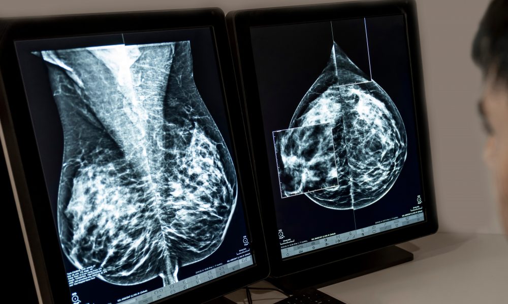 Women pay for AI to boost mammogram findings