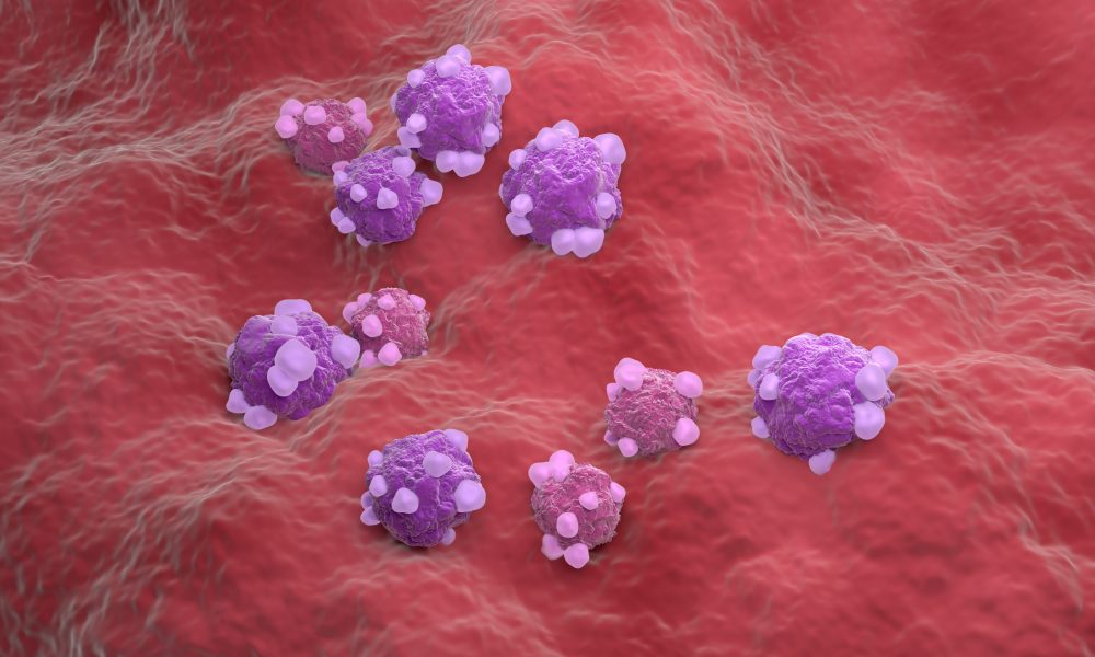 Promising results from ovarian cancer drug study