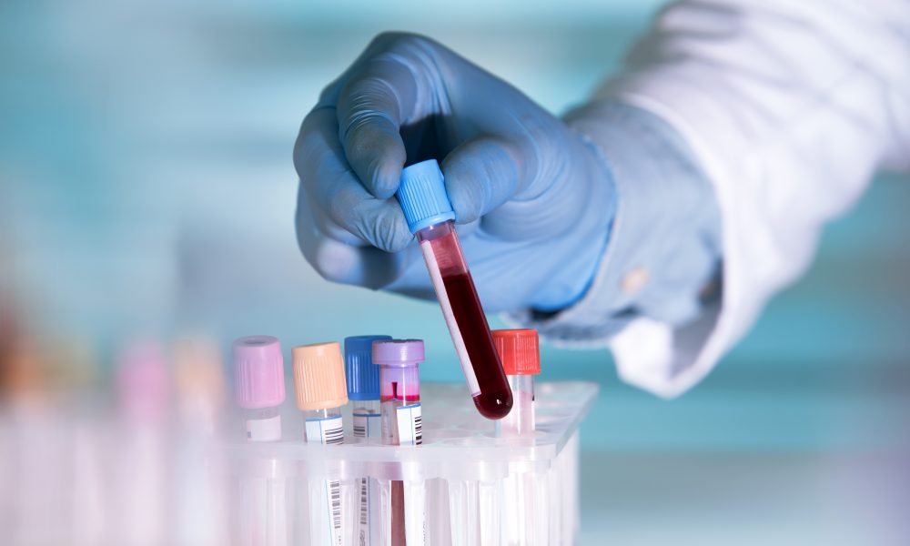 Blood test predicts 30-year risk of heart attack, stroke and cardiovascular death in women