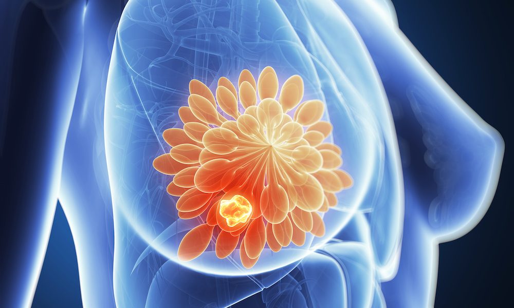 3d rendered illustration – breast cancer Oestrogens play a hidden role in cancers, inhibiting a key immune cell