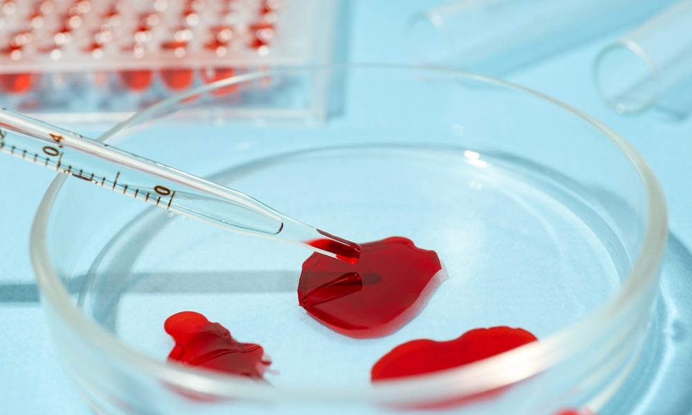 Scientists develop breakthrough approach to detecting endometriosis in menstrual blood