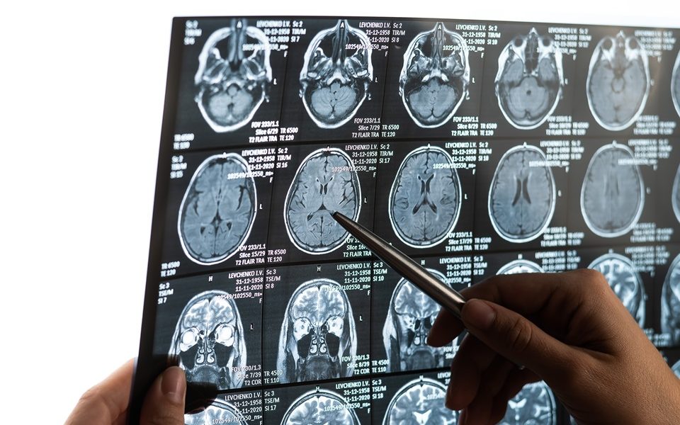 Women better protected against early Parkinson’s neurodegeneration, study finds